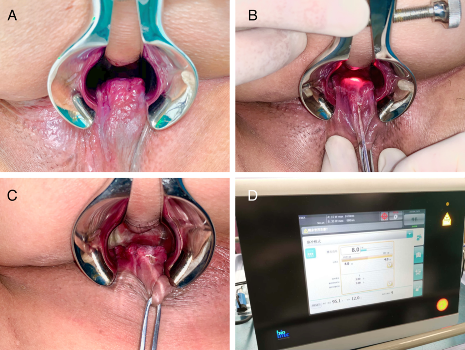 Laser hemorrhoidoplasty vs. rubber band ligation: a randomized trial comparing 2 mini-invasive treatment for grade II hemorrhoids