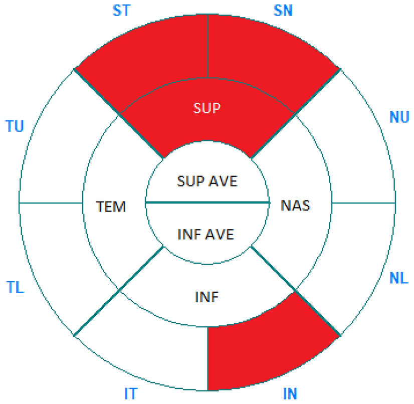 Evaluation of optical coherence tomography findings in patients with multiple sclerosis and glaucoma