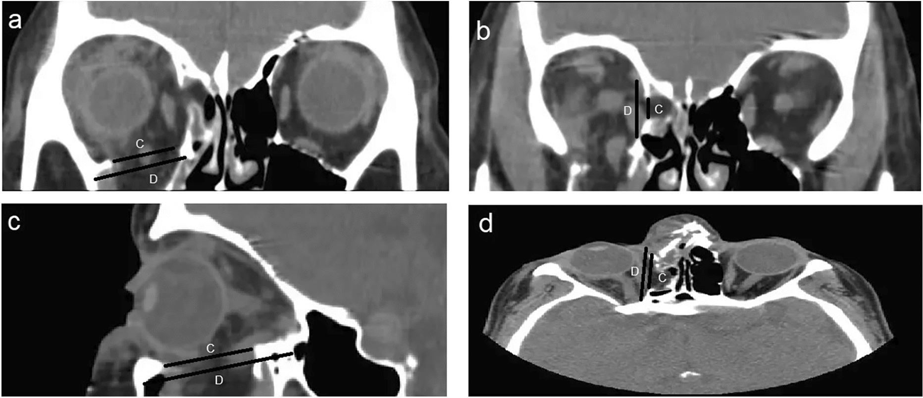 Prediction of substantial closed-globe injuries in orbital wall fractures