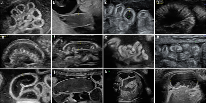 Prenatal ultrasound markers for prediction of complex gastroschisis—single-center retrospective cohort study