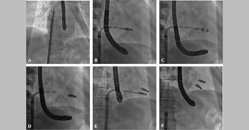 The Evolving Role of Transcatheter Tricuspid Valve Edge-to-Edge Repair in Tricuspid Regurgitation