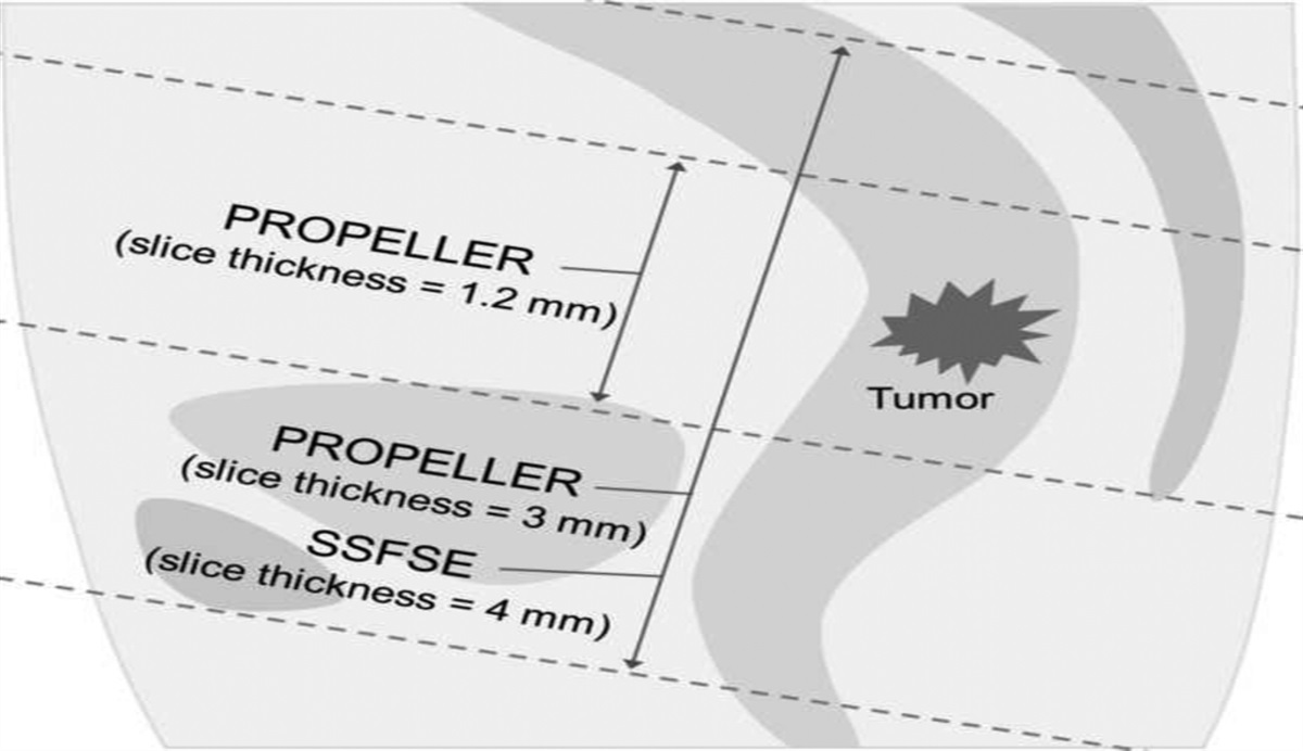 Ultra-High-Resolution T2-Weighted PROPELLER MRI of the Rectum With Deep Learning Reconstruction: Assessment of Image Quality and Diagnostic Performance