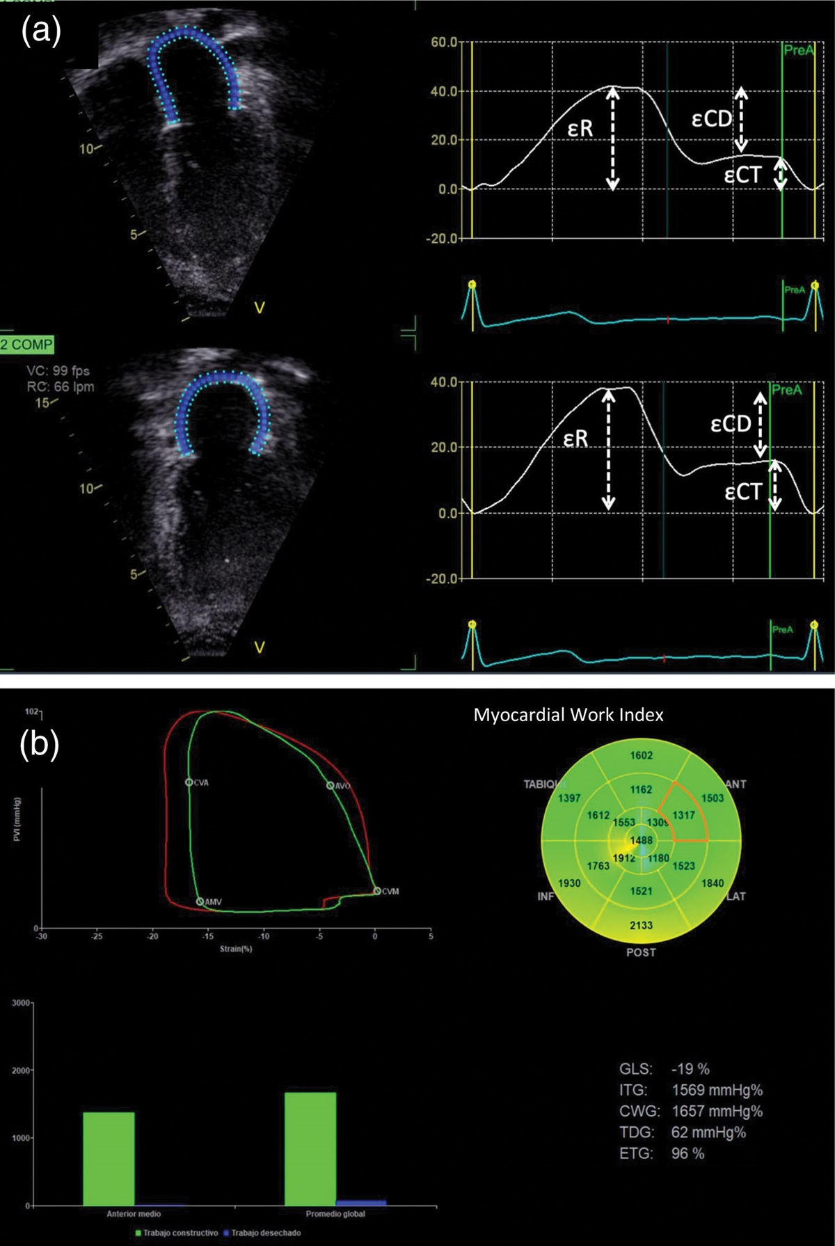 Myocardial function, mechanics and work by echocardiography in adolescents with severe obesity