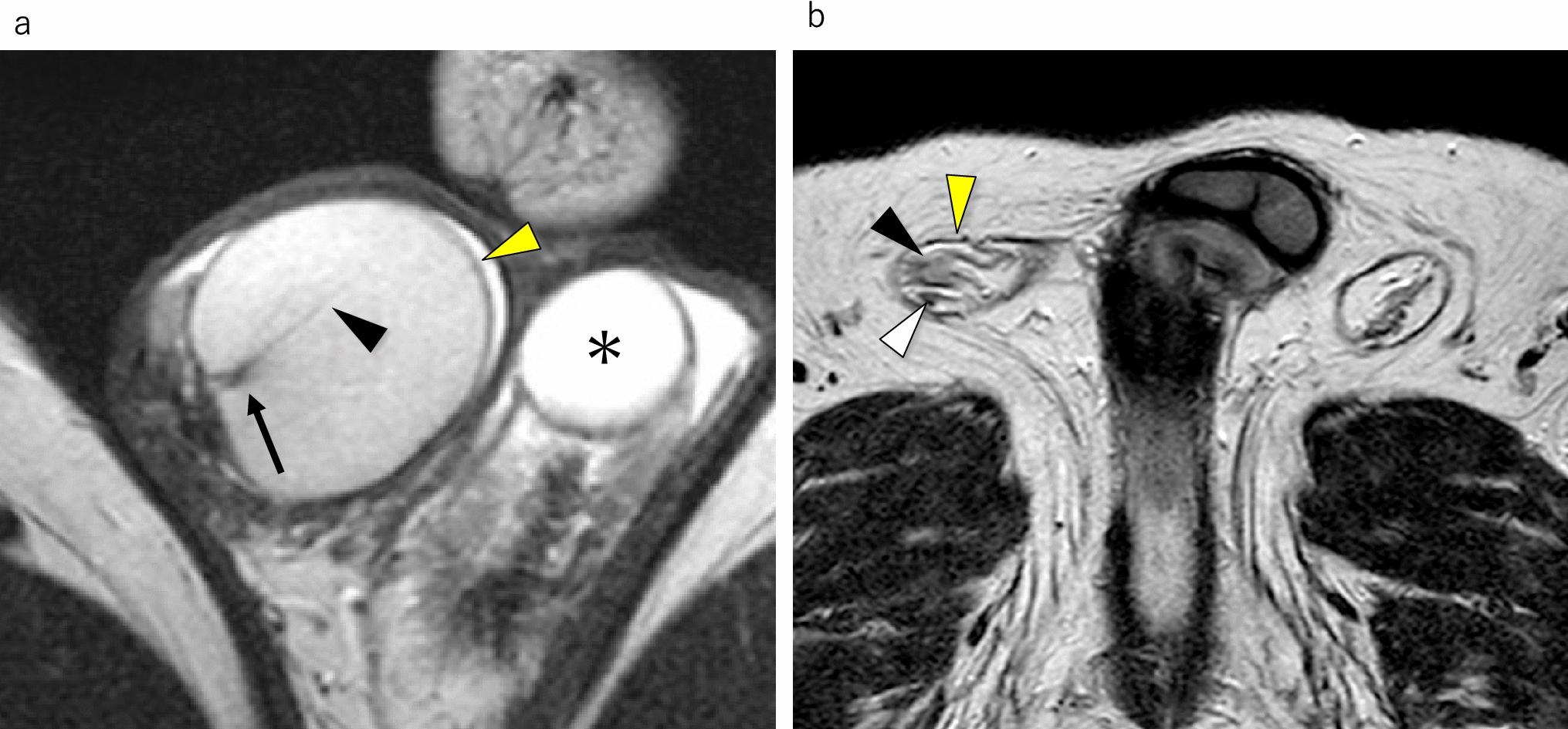 Extratesticular masses focusing on MRI findings