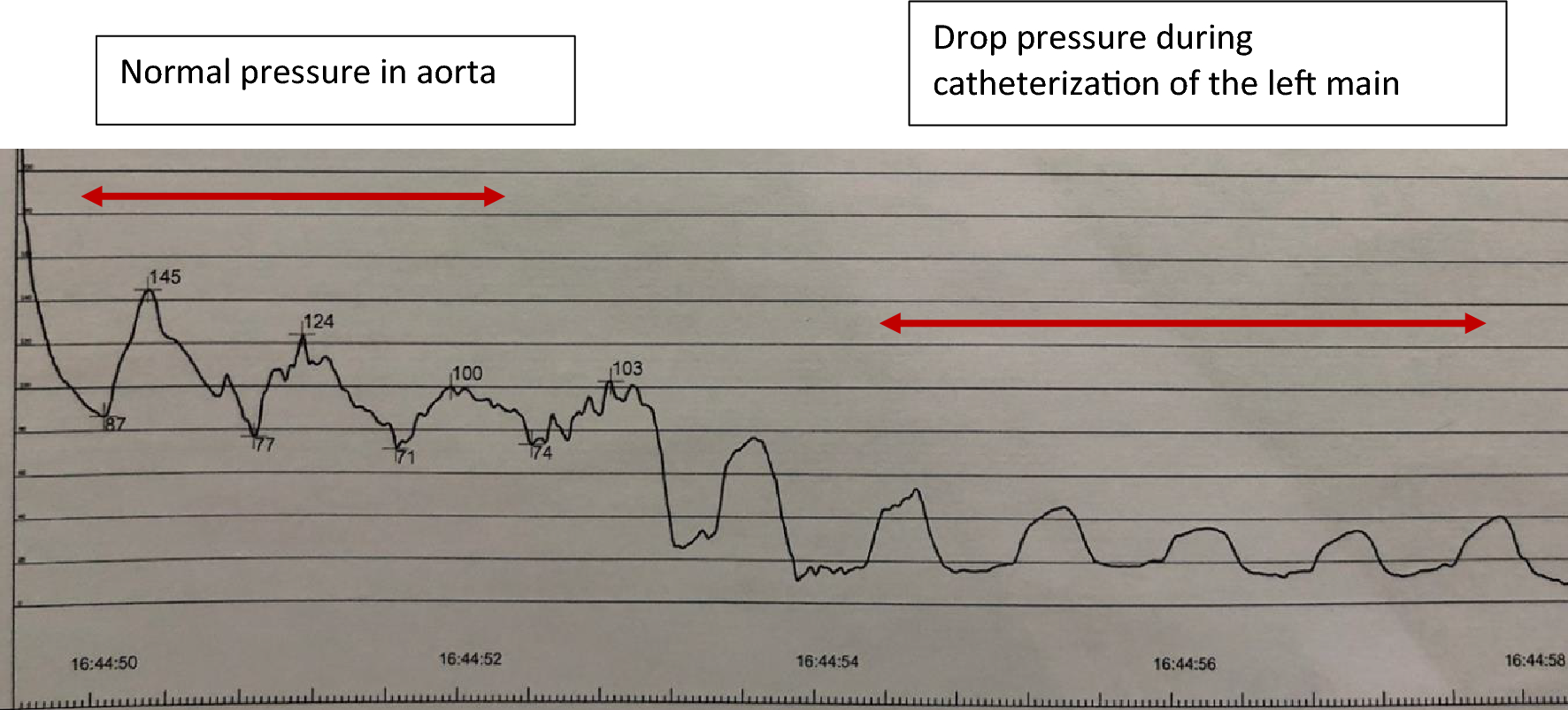 Radial artery avulsion: case report of a rare complication in interventional cardiology