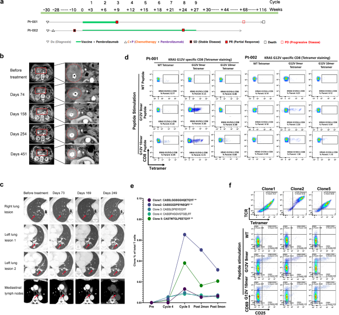 Combination therapy of KRAS G12V mRNA vaccine and pembrolizumab: clinical benefit in patients with advanced solid tumors