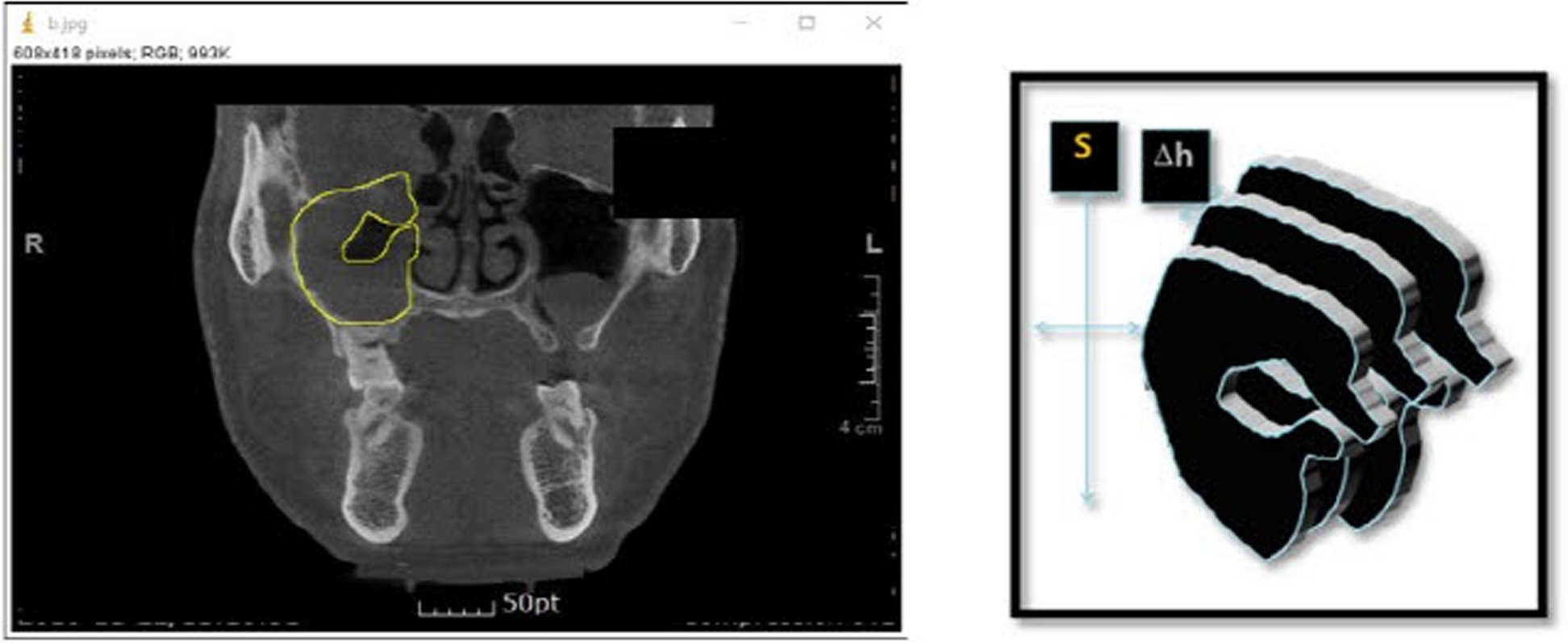 Sinus irrigation as an adjunctive therapy for odontogenic maxillary sinusitis — an in-depth analysis