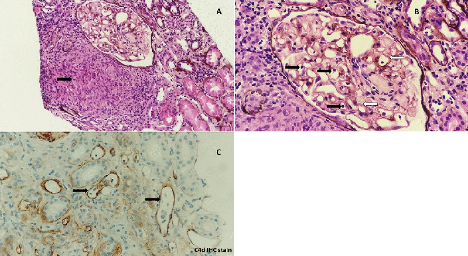 Report of renal allograft tuberculosis a decade after transplant: challenges in diagnosis and management