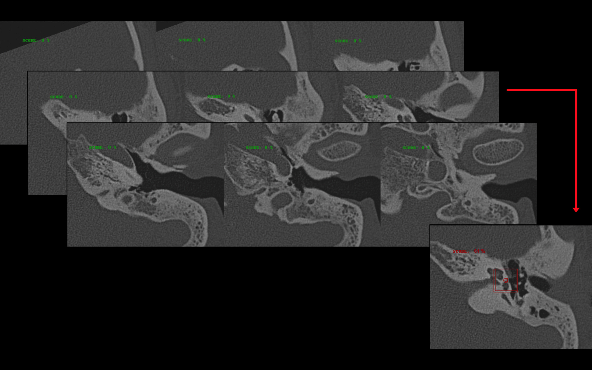 Artificial Intelligence for Otosclerosis Detection: A Pilot Study