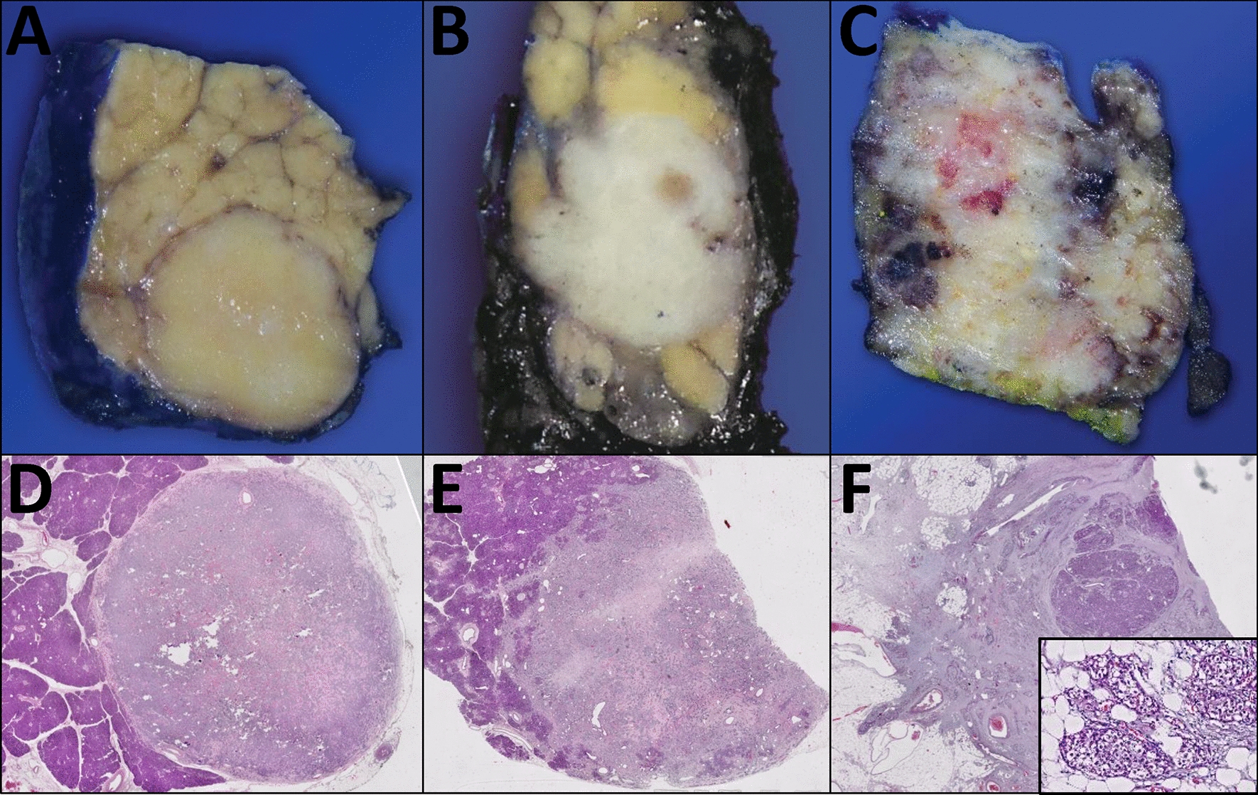 Subgrading of G2 Pancreatic Neuroendocrine Tumors as 2A (Ki67 3% to < 10%) Versus 2B (10% to ≤ 20%) Identifies Behaviorally Distinct Subsets in Keeping with the Evolving Management Protocols