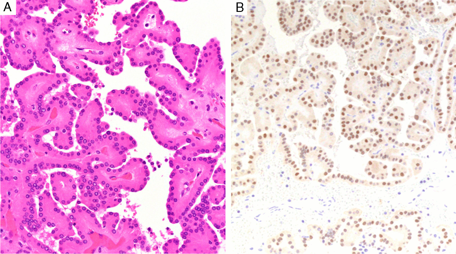 Papillary renal neoplasm with reverse polarity has low frequency of alterations in chromosomes 7, 17, and Y