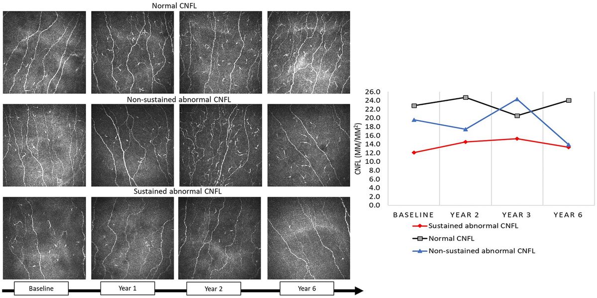 Sustained corneal nerve loss predicts the development of diabetic neuropathy in type 2 diabetes