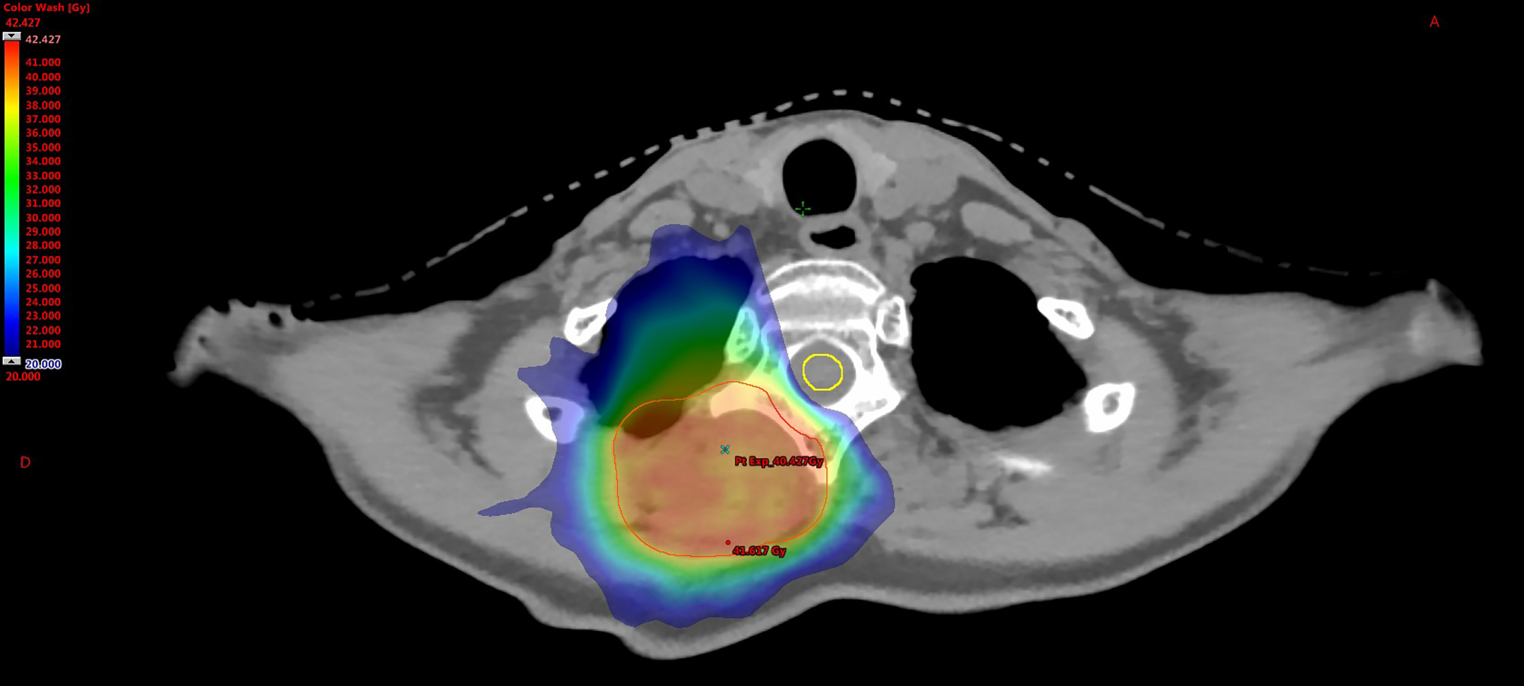 Tolerance of radiotherapy with concomitant glofitamab in diffuse large B cell lymphoma: a case report