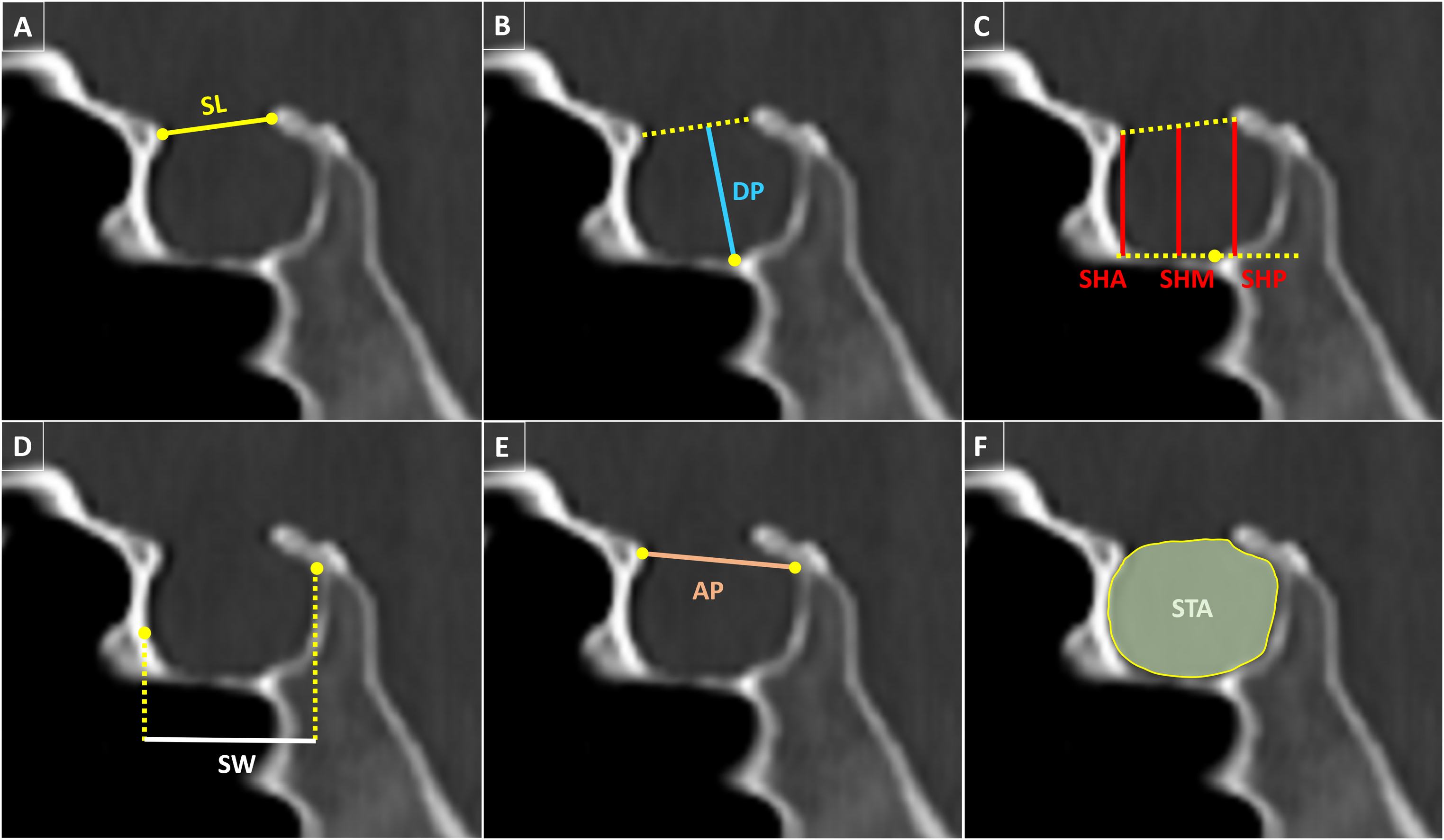 The relationship between sphenoidal sinus and sella turcica morphometry in the Turkish population: a retrospective study