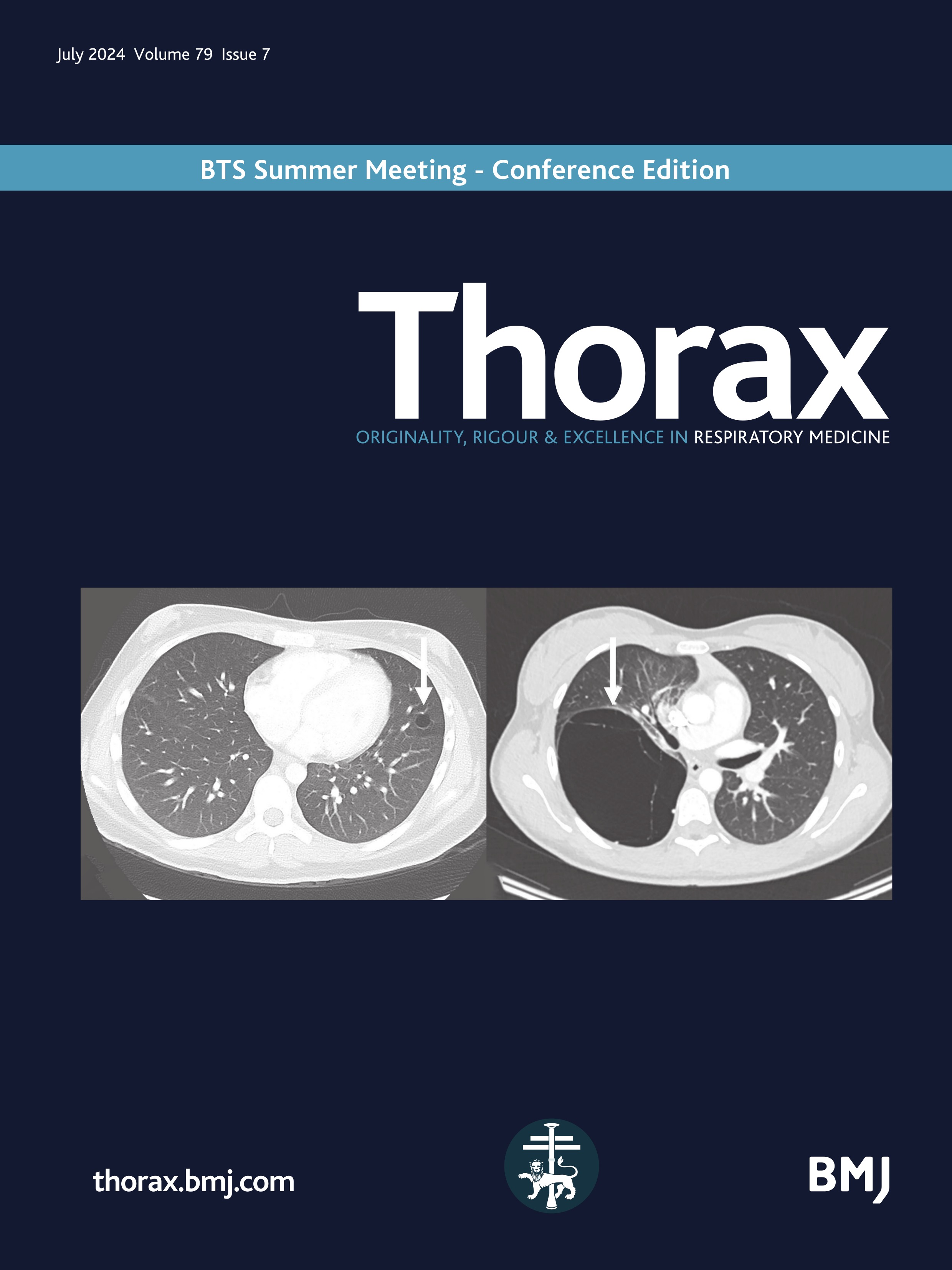 Incidence, prevalence and mortality of idiopathic pulmonary fibrosis in England from 2008 to 2018: a cohort study