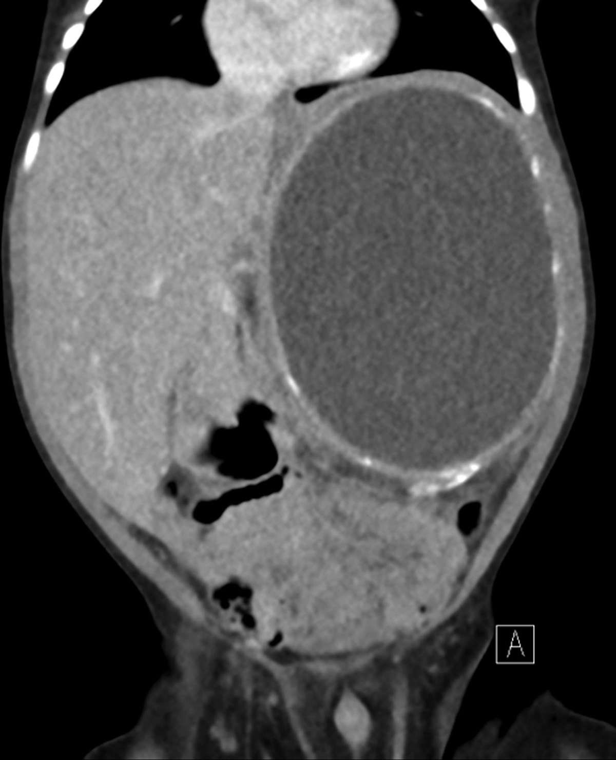 The Unexpected Evolution of a Neonatal Adrenal Hemorrhage in a Male Child