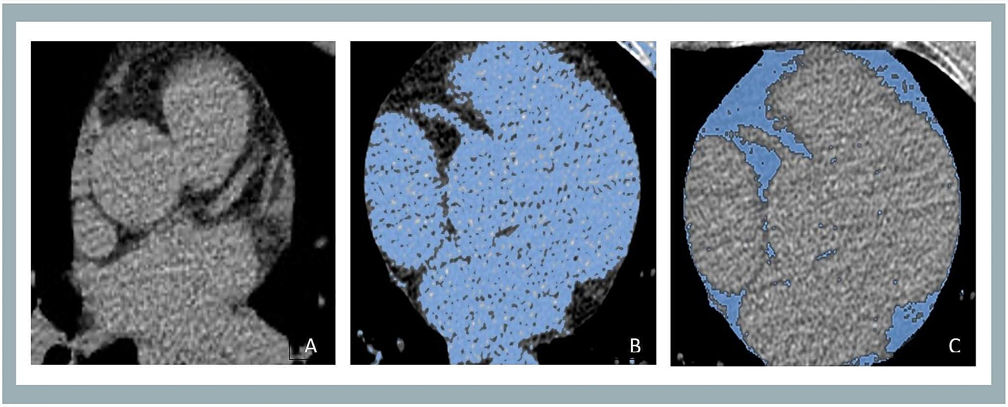 Exploring the relationship between epicardial fat and coronary plaque burden and characteristics: insights from cardiac ct imaging