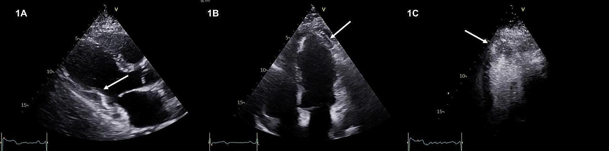 Atypical left-ventricular hypertrophy with apical aneurysm in leopard syndrome