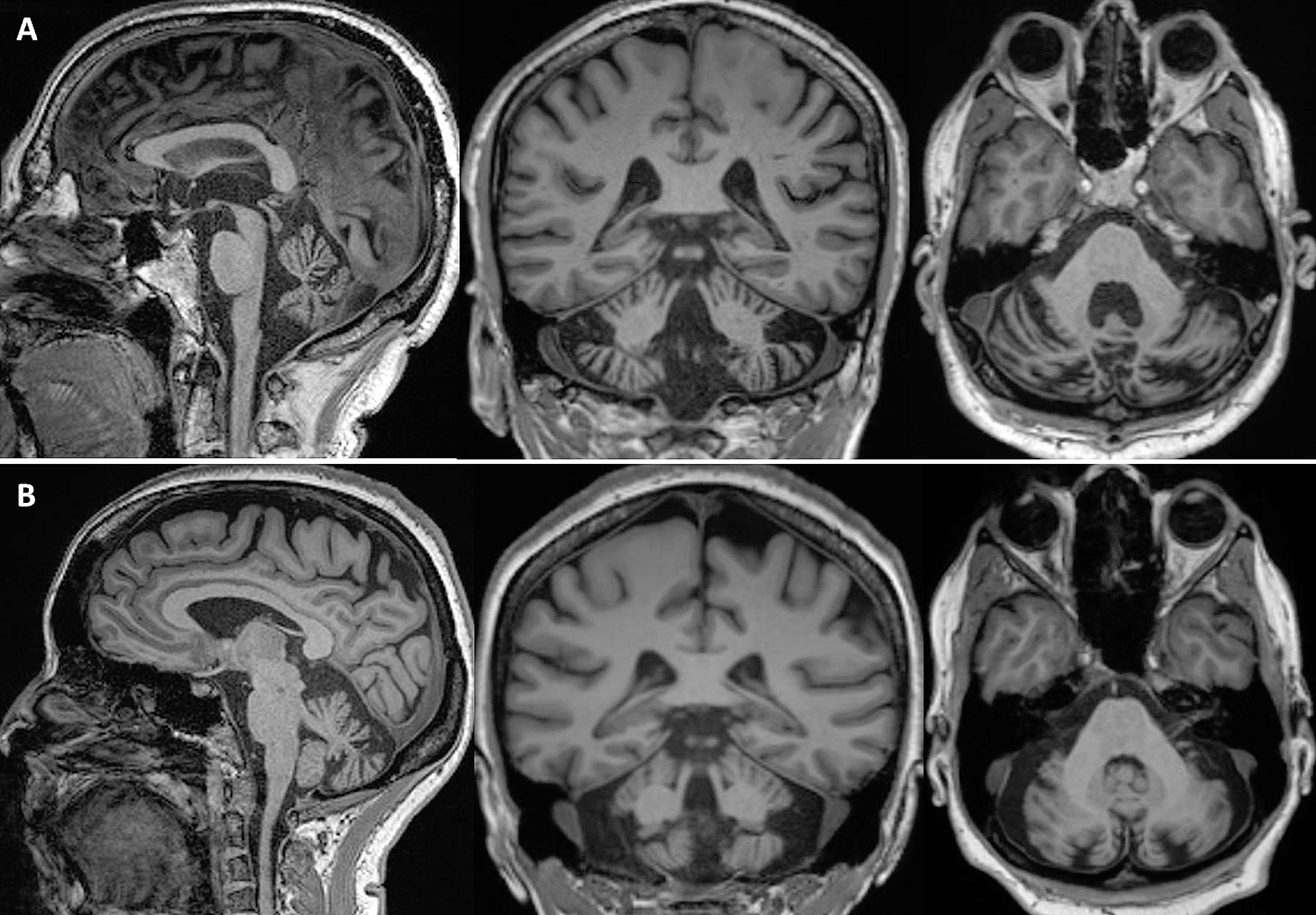 Two more families supporting the existence of monogenic spinocerebellar ataxia 48