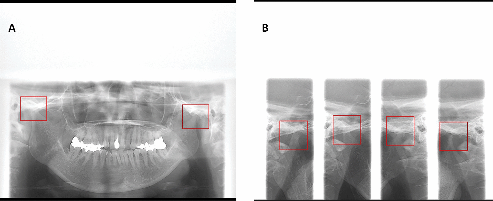 Deep learning classification performance for diagnosing condylar osteoarthritis in patients with dentofacial deformities using panoramic temporomandibular joint projection images