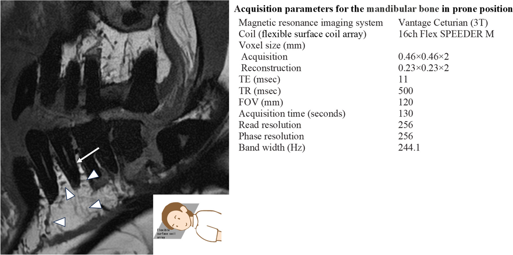 Prone position magnetic resonance imaging for the mandibular bone: enhancing image quality to perform texture analysis for medication-related osteonecrosis of the jaw and carcinoma of the lower gingiva