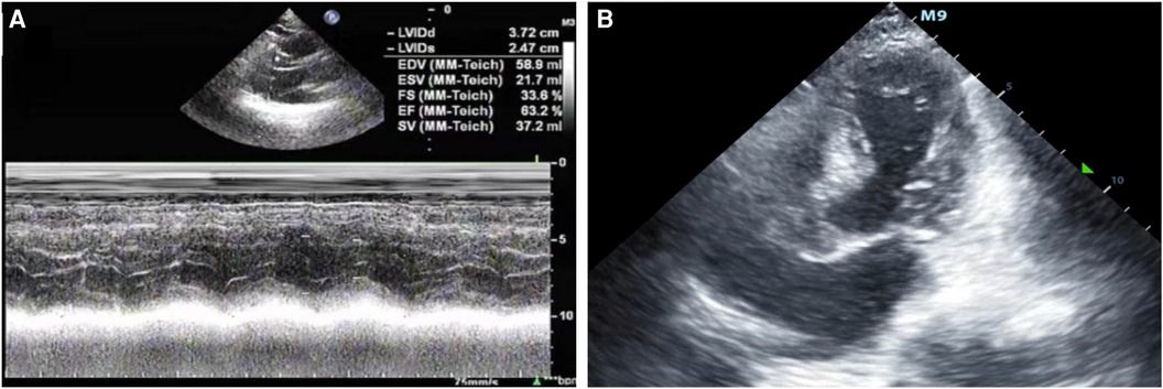 ATAK complex (adrenaline, takotsubo, anaphylaxis, and kounis hypersensitivity-associated coronary syndrome) related to latamoxef administration—a case report