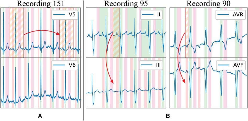 Generalising electrocardiogram detection and delineation: training convolutional neural networks with synthetic data augmentation