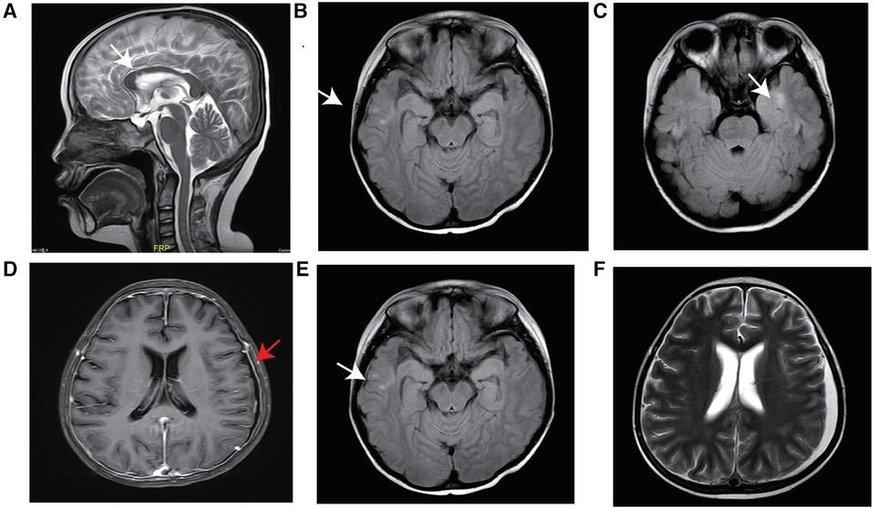 An efficient and successful outcome after haematopoietic stem cell transplantation in a patient with an LPS-responsive beige-like anchor gene mutation