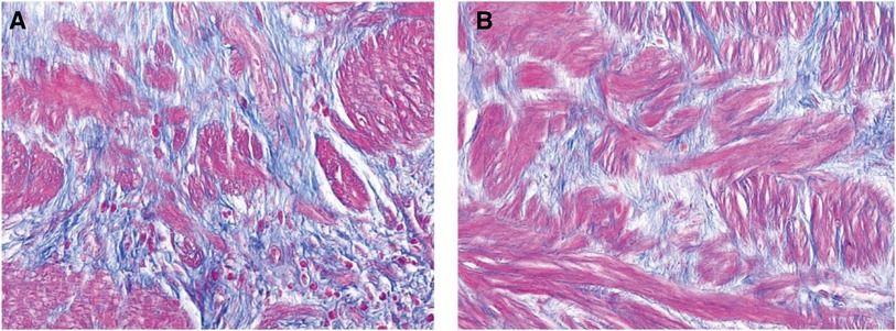 Pathological characteristics analysis of children with intermittent and persistent hydronephrosis due to uretero-pelvic junction obstruction