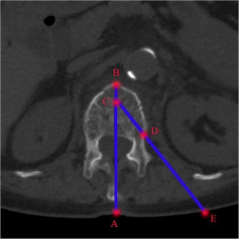 Comparison of the clinical effect of unilateral transverse process extrapedicular and bilateral transpedicular percutaneous kyphoplasty for thoracolumbar osteoporotic vertebral compression fracture