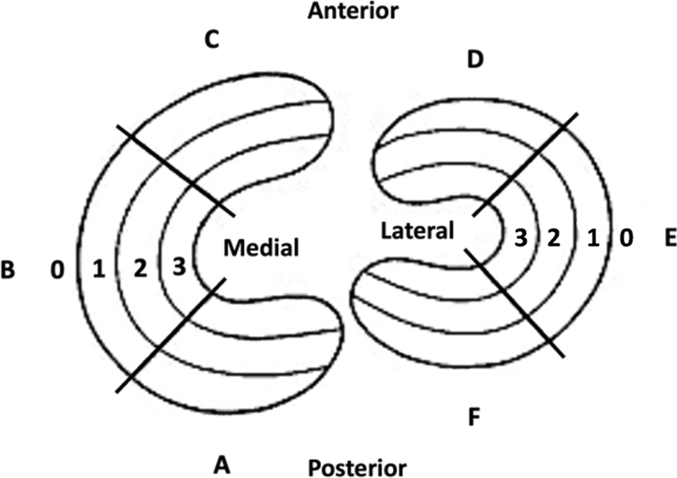 Meniscal Lesions in Multi-Ligament Knee Injuries