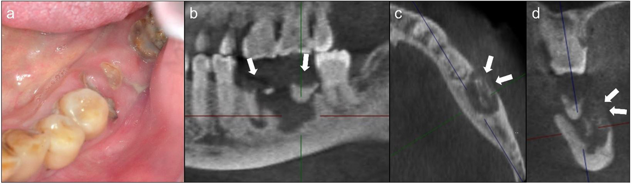 Key insights into antiresorptive drug use and osteonecrosis in osteoporotic patients undergoing tooth extractions: A clinical and CBCT assessment