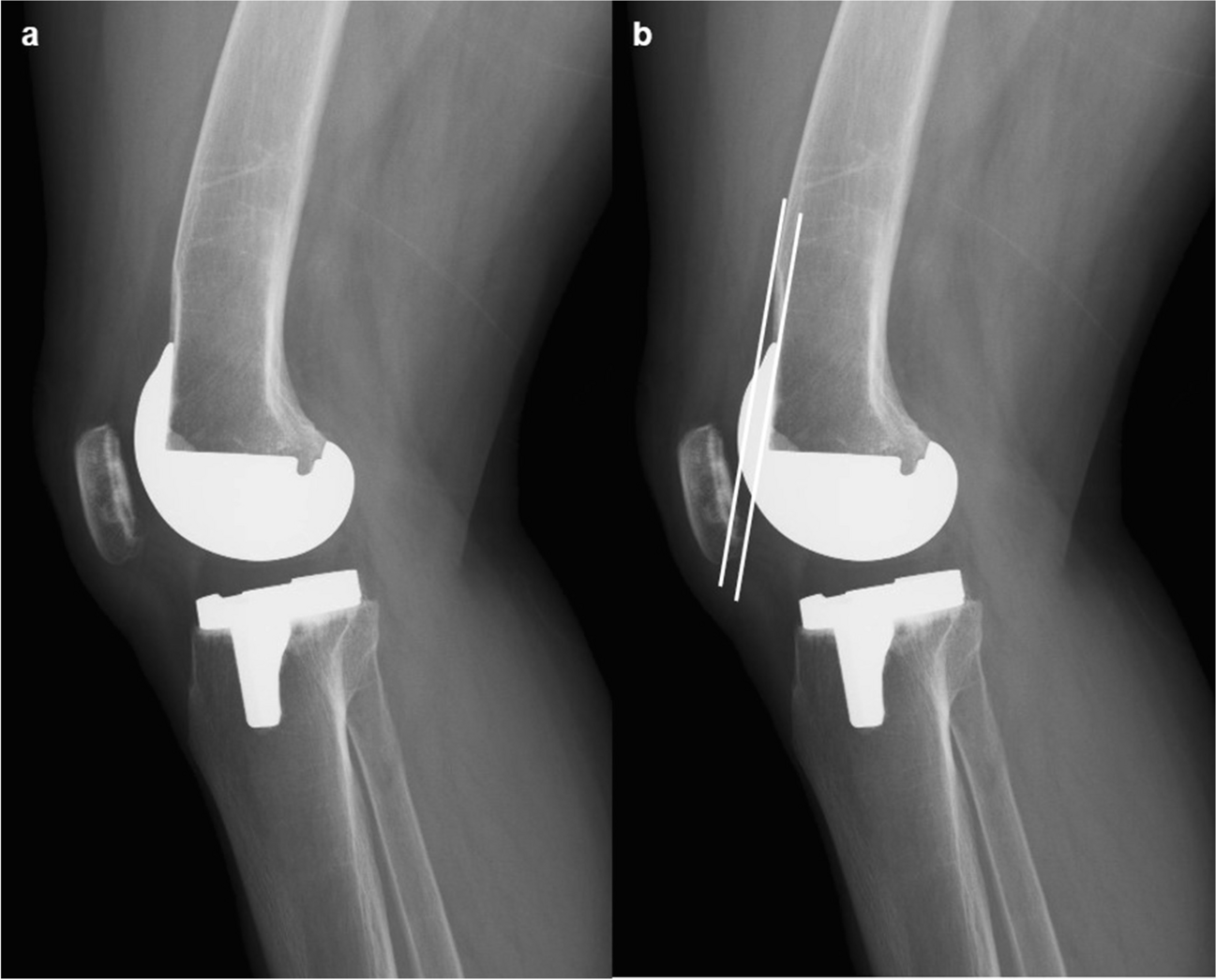 Total knee arthroplasty and periprosthetic distal femoral fracture: looking beyond the osteoporosis to previous osteoporotic fracture