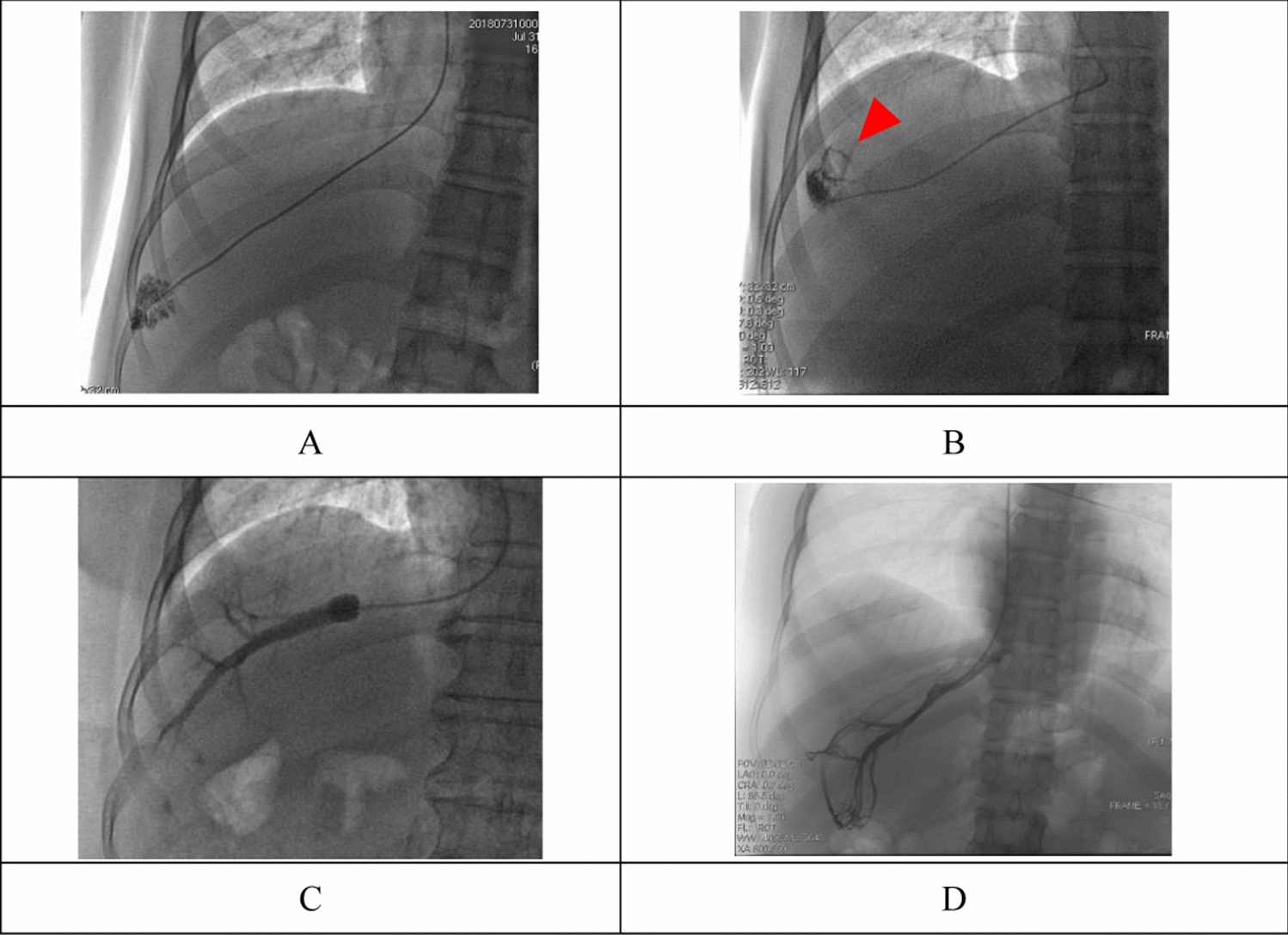 The Balloon Catheter Method and the End-hole Catheter Method in the Measurement of Hepatic Venous Pressure Gradient: a Comparative Study