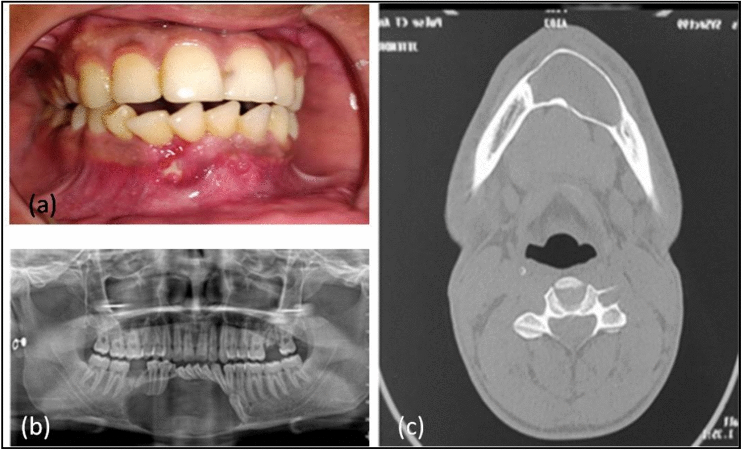 Rare Occurrence of Epidermoid Inclusion Cyst in the Mandible: A Solitary Case Report and Review of Literature