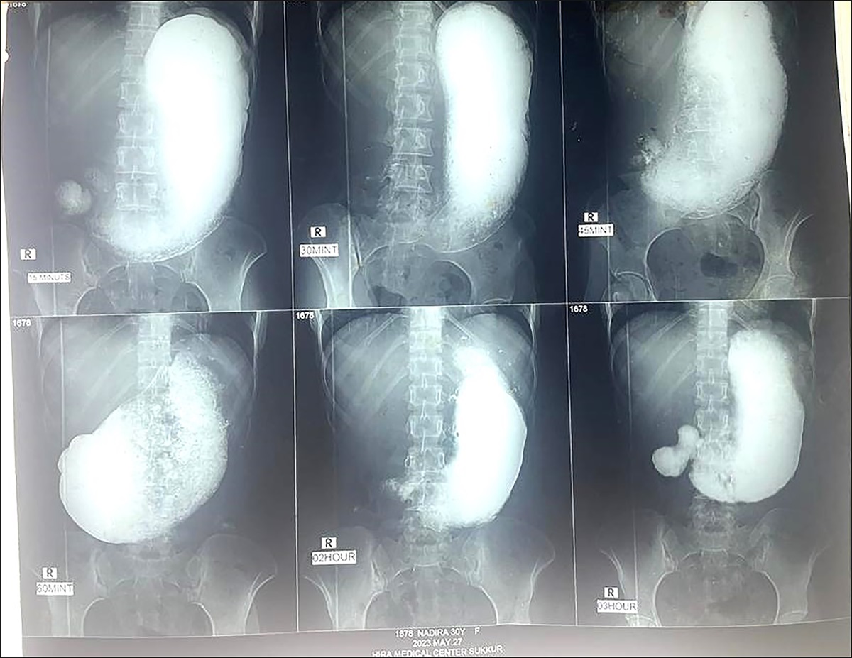 Extensive Cytomegalovirus Gastroduodenitis Causing Gastric Outlet Obstruction in an Immunocompetent Patient