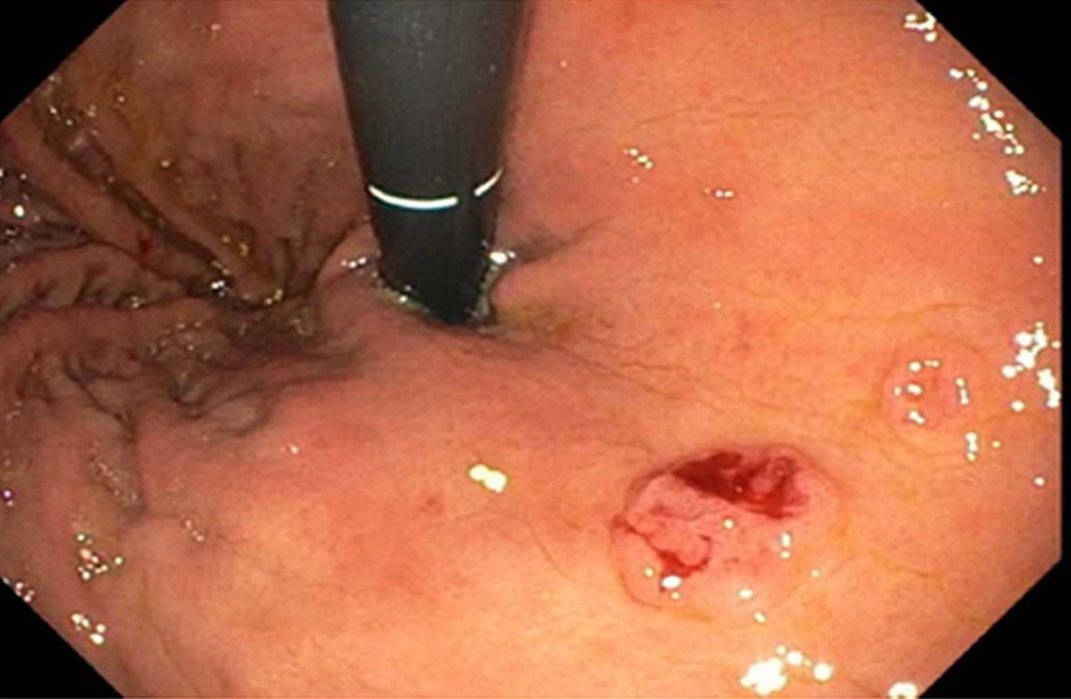 Unveiling Multiple Myeloma: Actively Bleeding Extramedullary Gastric Myelomas Lead to Diagnosis