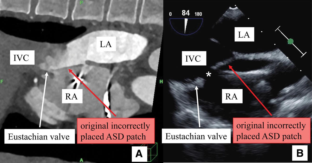 Usefulness of Transesophageal Echocardiography in Diagnosing the Cause of Circulatory Collapse During Reoperation for an Inferior Vena Cava-Left Atrium Shunt After Atrial Septal Defect Closure: A Case Report