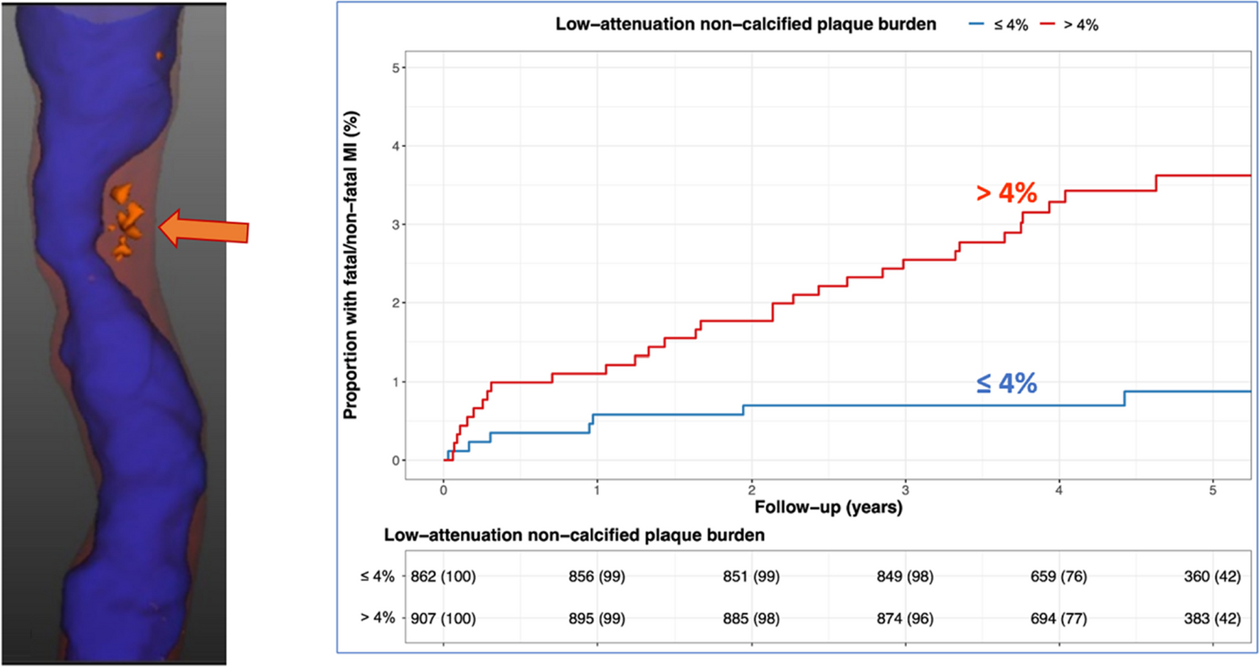 Noninvasive Atherosclerotic Phenotyping: The Next Frontier into Understanding the Pathobiology of Coronary Artery Disease