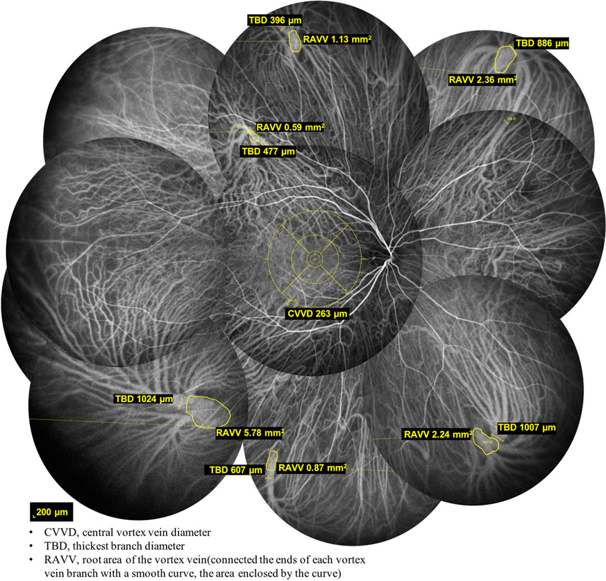 Age-related alterations in vortex veins on indocyanine green angiography