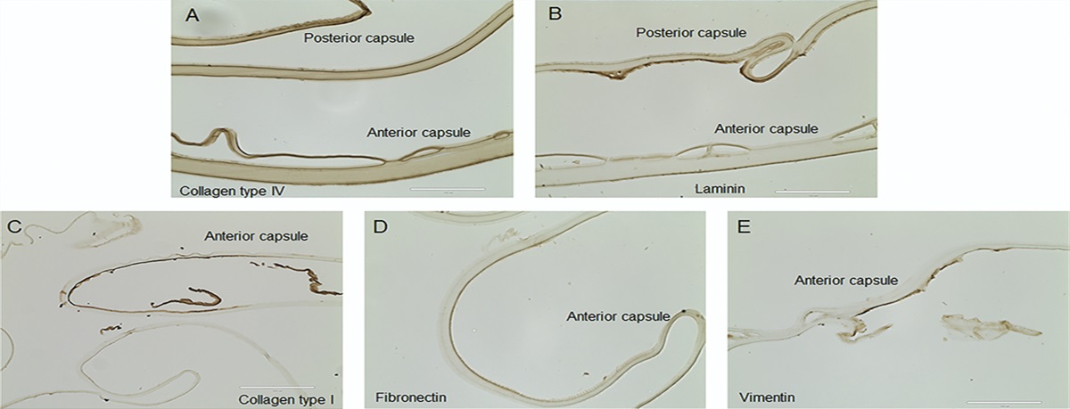 Immunohistochemical findings of lens capsules obtained from patients with dead bag syndrome