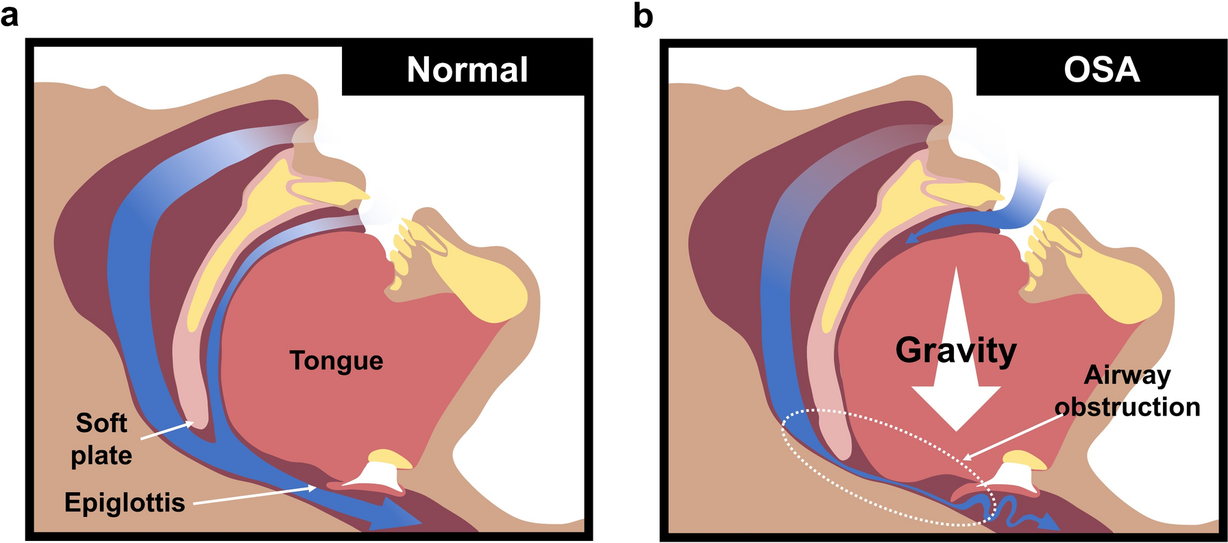 Computational analysis on 3D airway model of obstructive sleep apnea patient for optimal maxillomandibular advancement