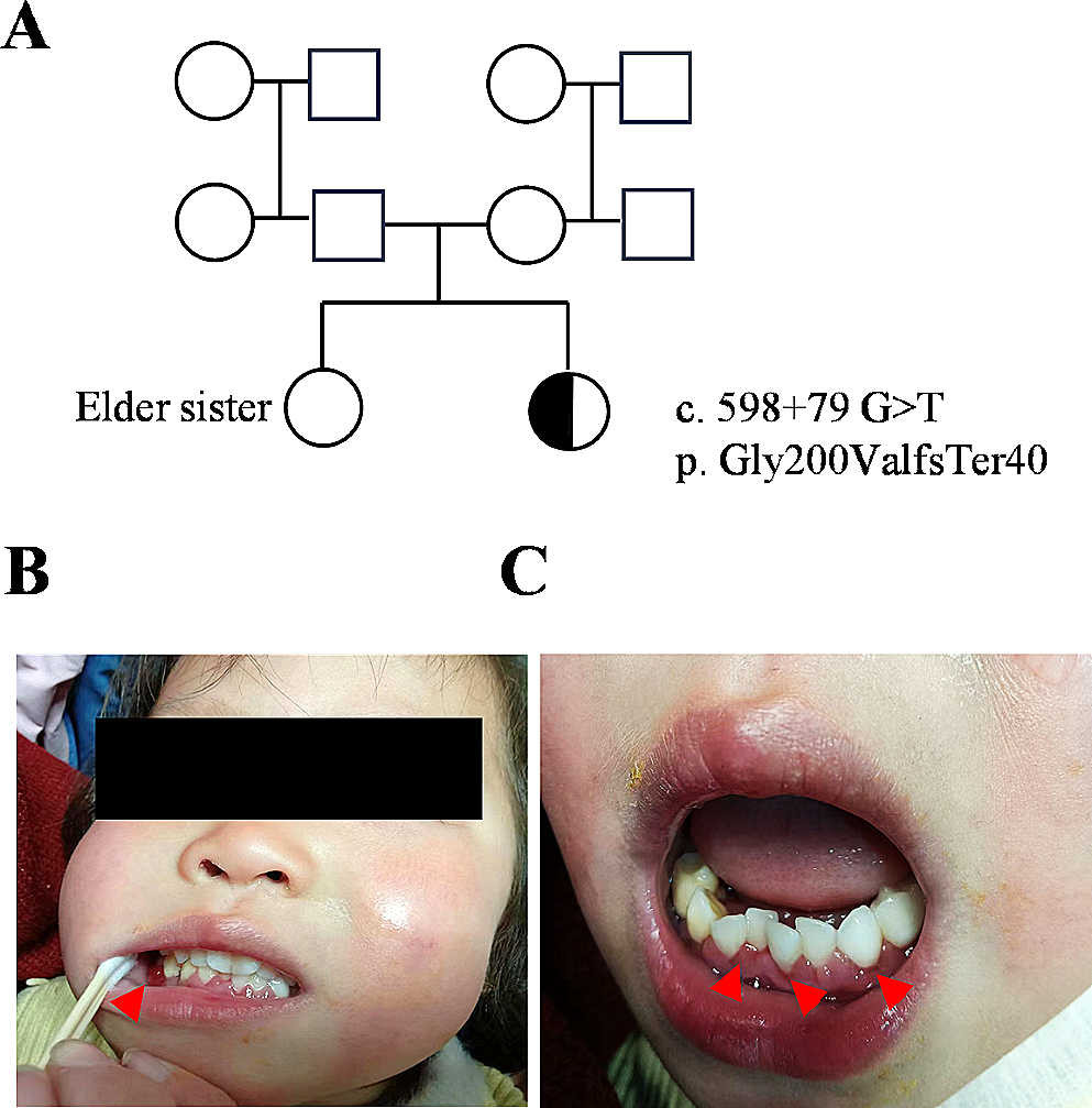 De Novo Deep Intron ELANE Mutation Resulting in Severe Congenital Neutropenia