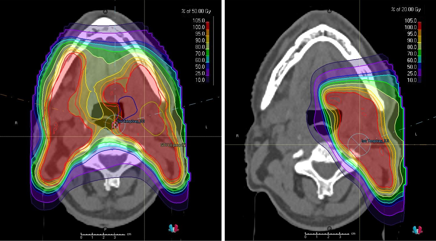 Proton pencil beam scanning radiotherapy in the postoperative treatment of p16 positive squamous cell tonsillar cancer – evaluation of toxicity and effectivity