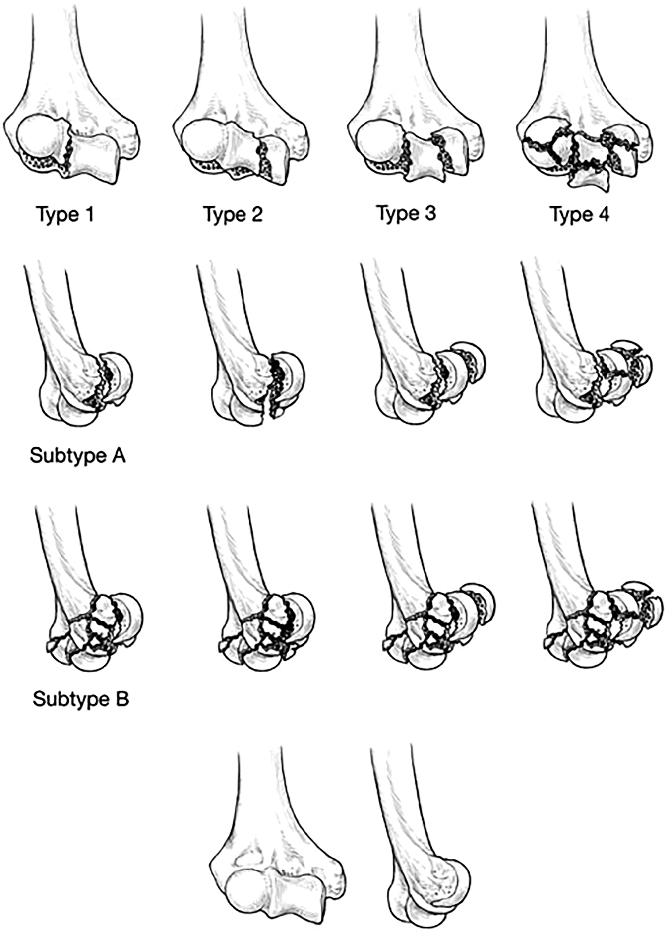 Coronal shear fractures of the distal humerus