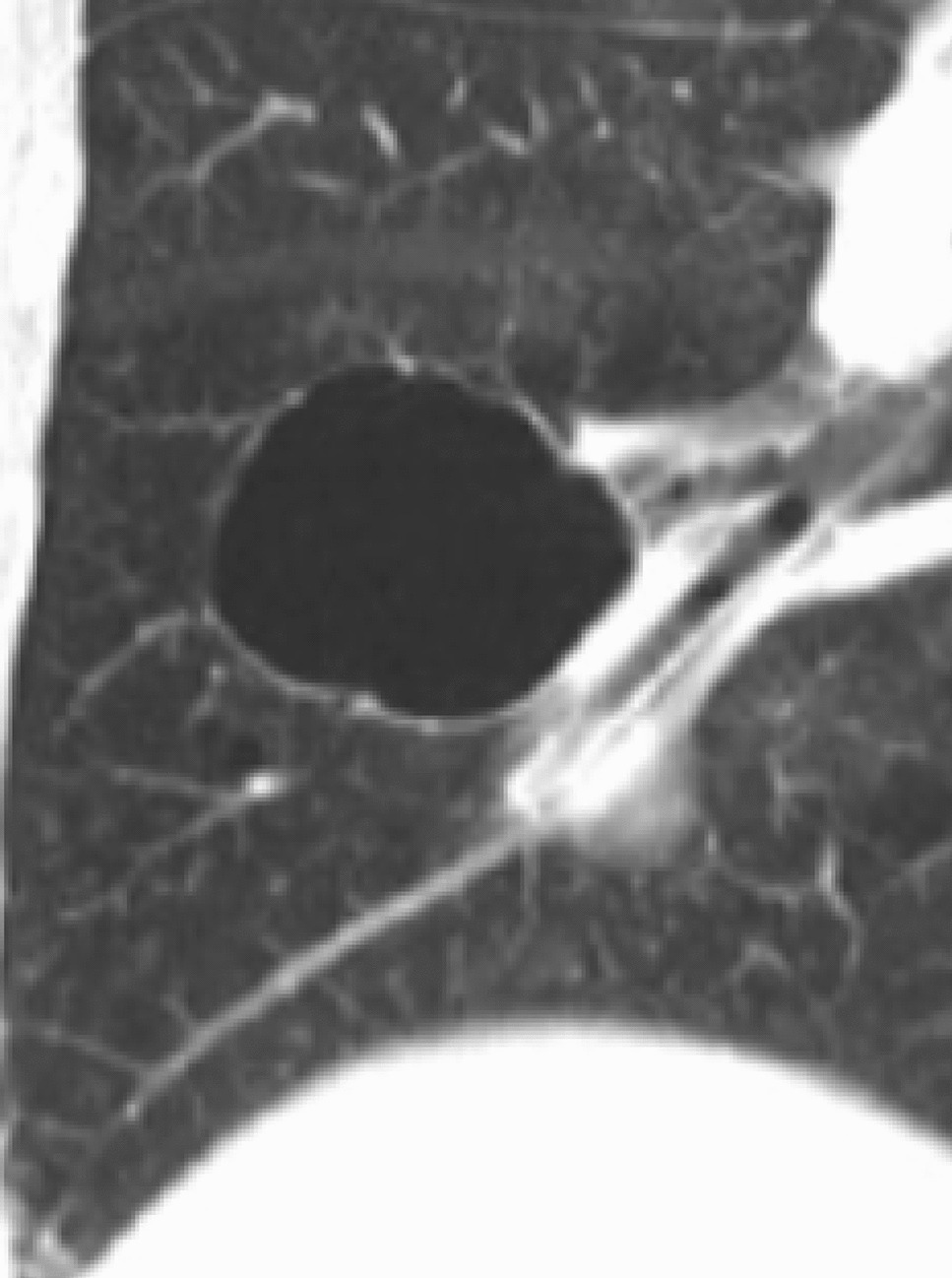 Cystic Lung Diseases: A Radiology Primer