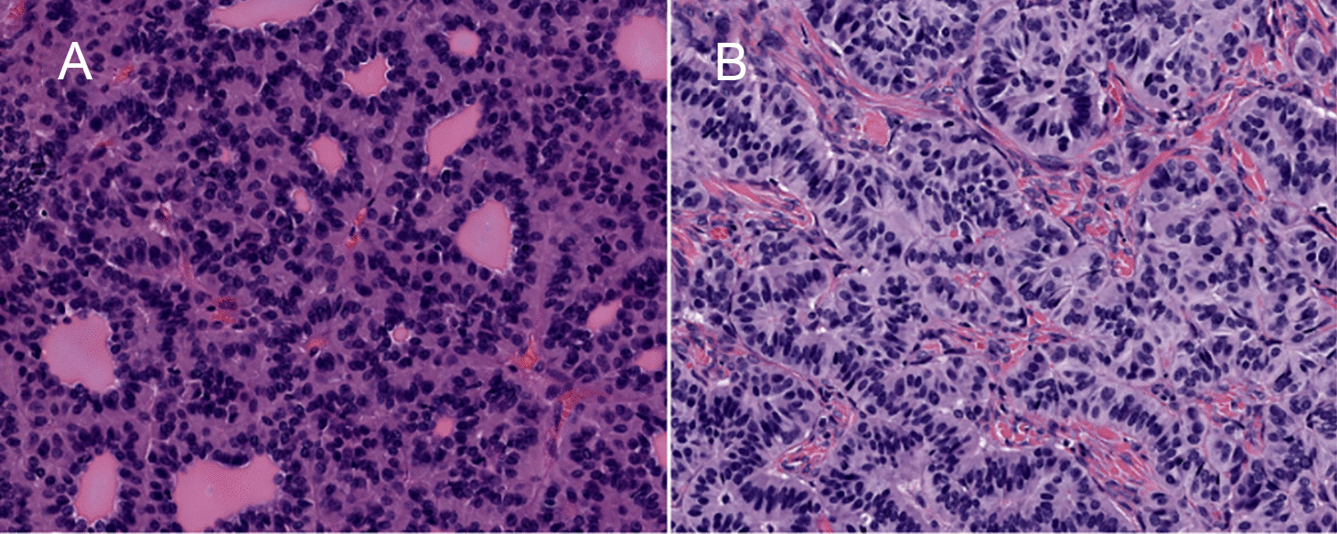 “Strumal Carcinoid”: A Well-Described but Unexplained Intratumoral Tumor