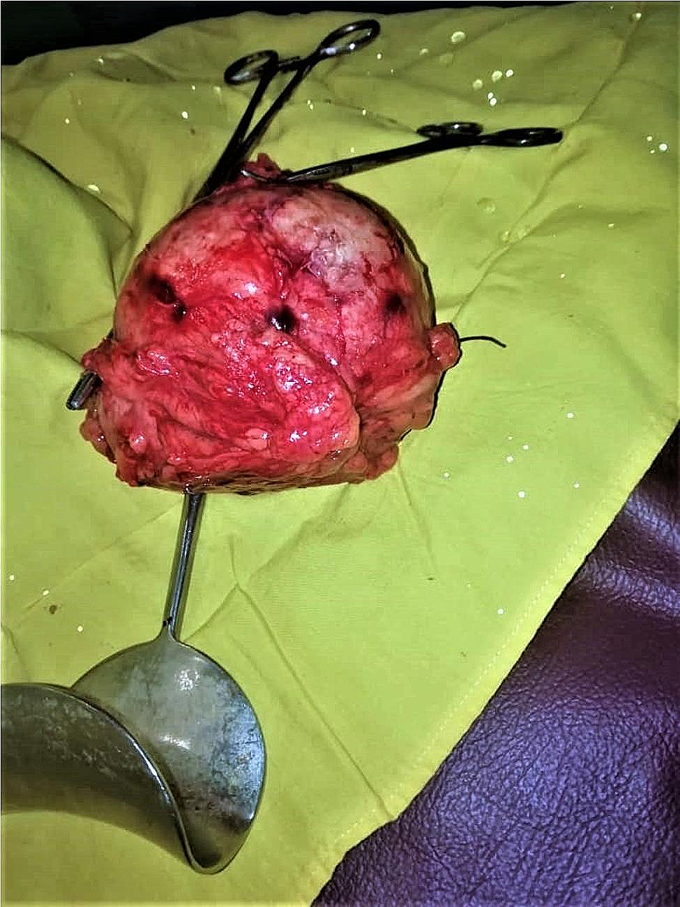 Unintentionally retained lap sponge mimicking an ovarian cyst two years after Caesarean section in a 37-year old patient: case report of a rare “never event” in Sudan