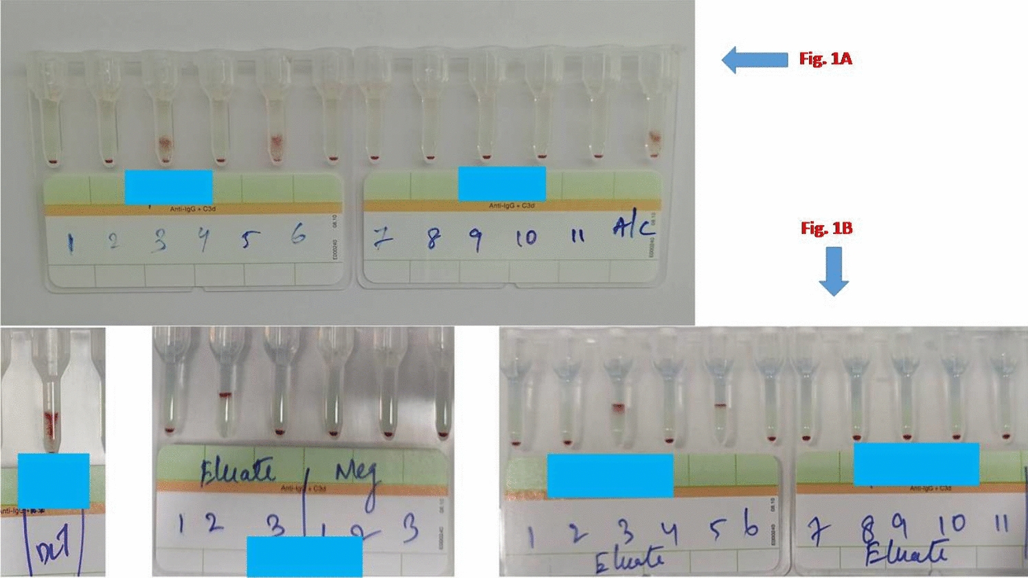 ABO-Mismatch Hematopoietic Stem Cell Transplantation with Pre-existing Red Cell Alloantibody Resembling a Case of Post-transplant Autoimmune Hemolytic Anemia