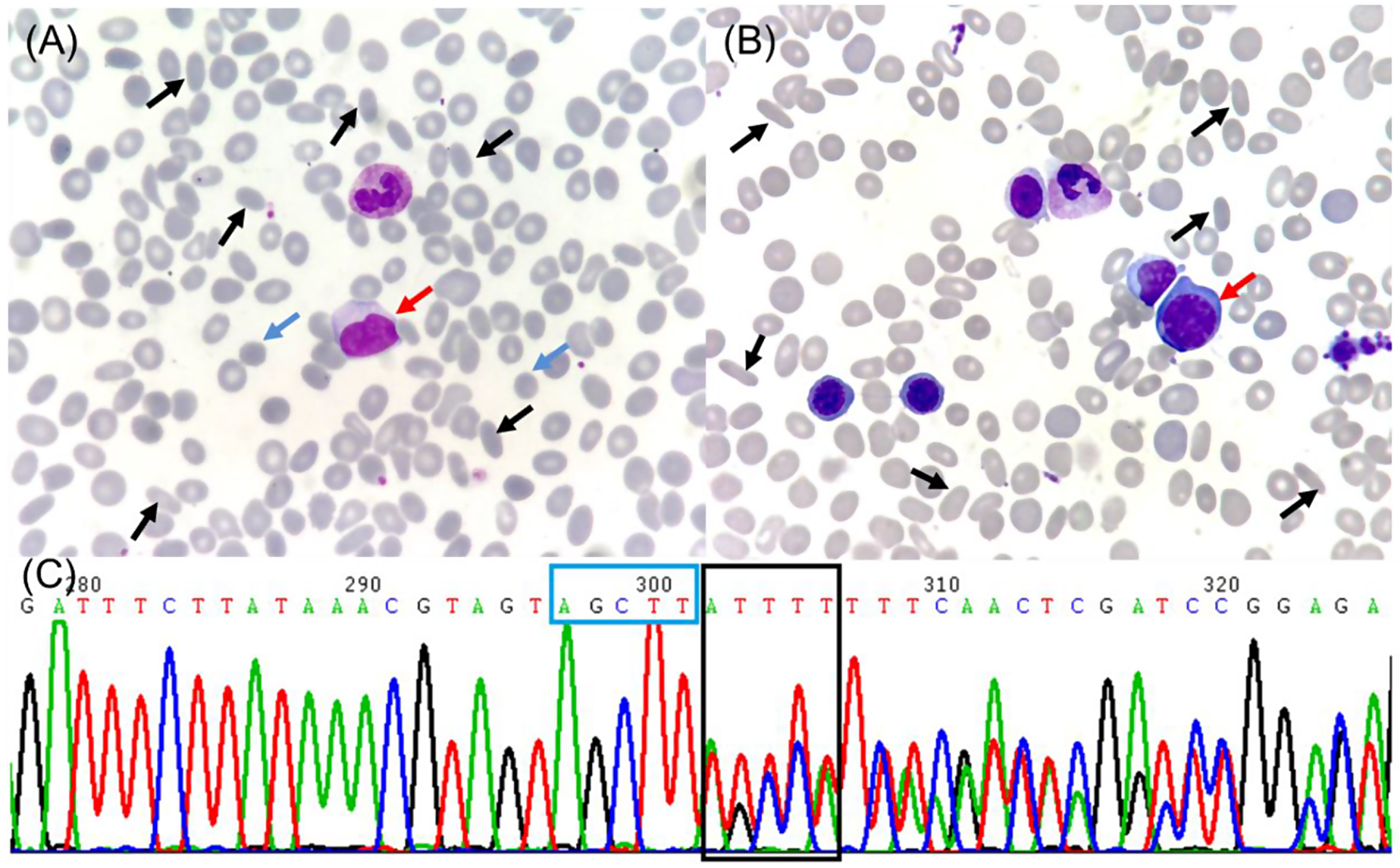 Frameshift Mutation in the EPB41 Gene with Hereditary Elliptocytosis